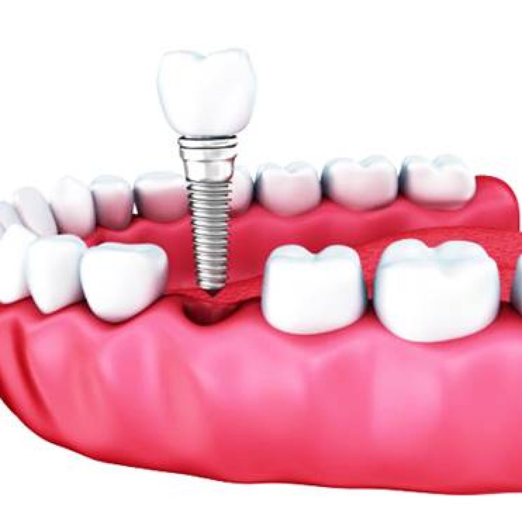 EndostealImplantsMarket The Camping Canuck