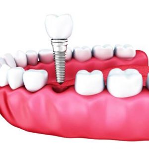 Endosteal Implants Market